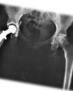 De invloed van botcement (MMA) en plaatjes van titanium, RVS en aluminium op de viabiliteit van osteoblasten