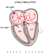 Samenvatting Circulatie en Long, casus angina pectoris & atrium fibrilleren