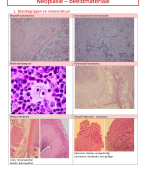 Neoplasie (Mechanismen van Ziekten)