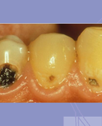 Tandheelkunde samenvatting Cariologie en harde tandweefsels Bachelor 2