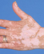 Dermatologie Klinische Samenvatting Ziektebeelden